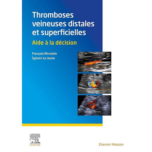 Thromboses veineuses distales et superficielles  - Aide à la décision - Campus